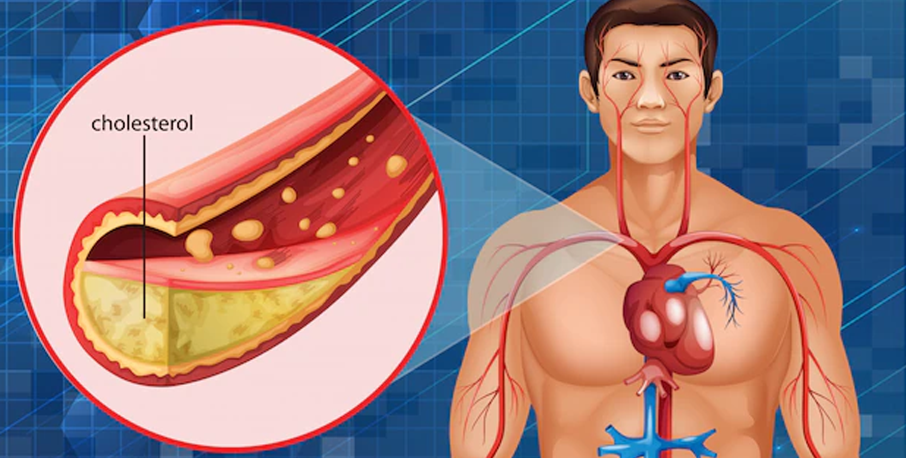 dislipidemia